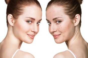 5 Tips για να Καλύψετε τα Σπυράκια στο Πρόσωπο - LadiesWorld.gr