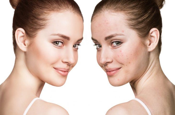 5 Tips για να Καλύψετε τα Σπυράκια στο Πρόσωπο - LadiesWorld.gr
