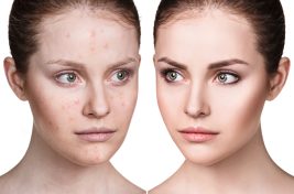 Ακμή: 7 Super Tips για πρόληψη και αντιμετώπιση! (2019) - LadiesWorld.gr